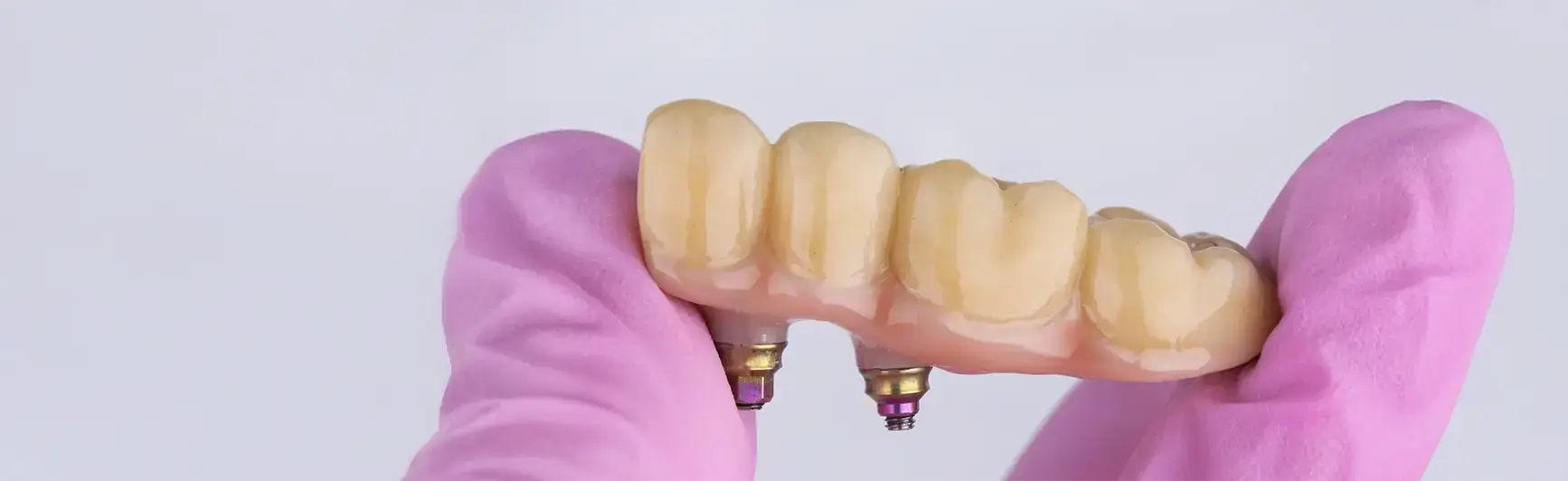 Implant crown/bridge